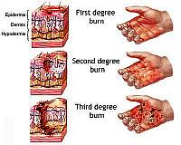 1st, 2nd, and 3rd degree burns